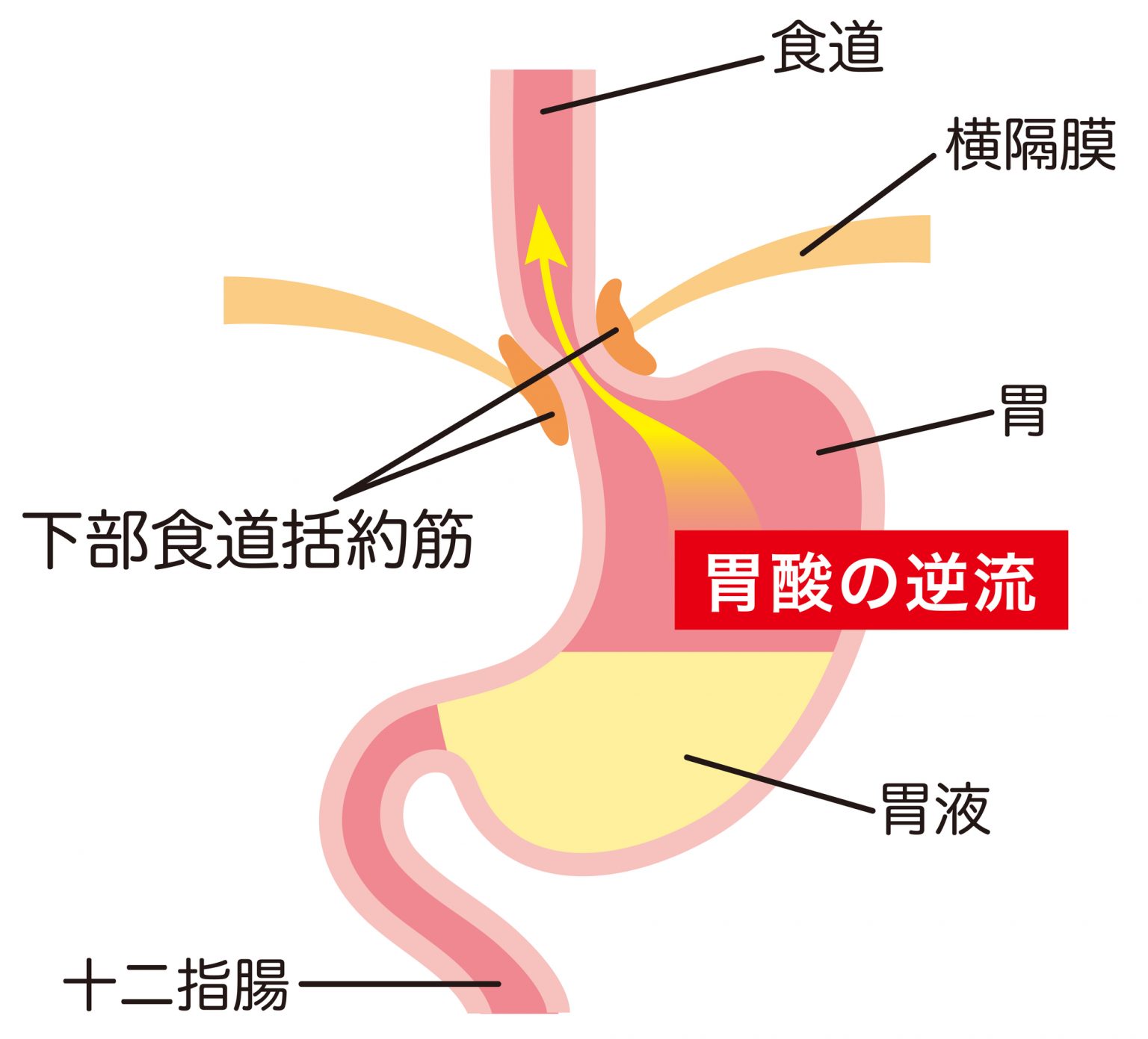 逆流ストッパー】逆流性食道炎の胸焼けを抑える傾斜すのこ - 枕